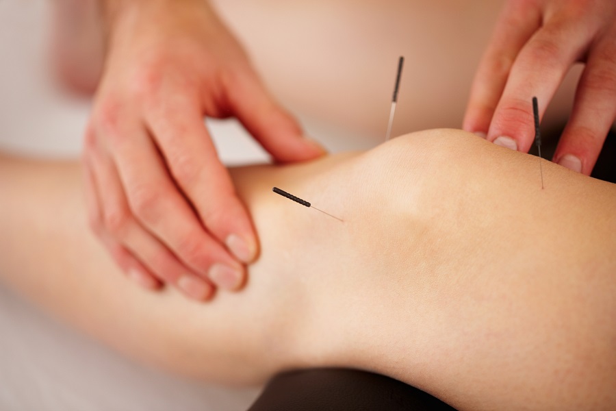 Acupuncture in Burlington 