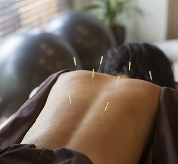 Acupuncturist in Burlington