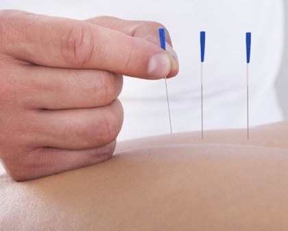 Acupuncture 